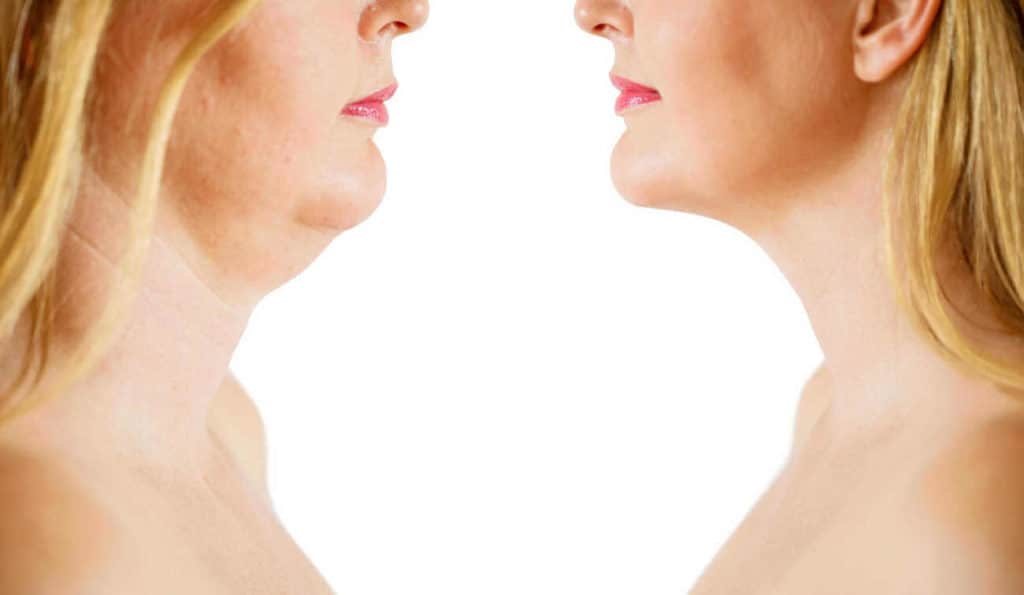 Double Chin treatment Altrincham before and after results