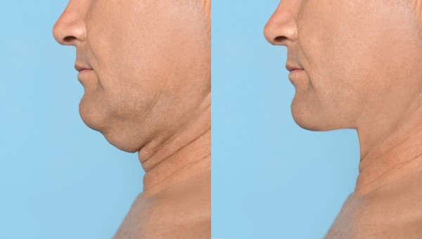 Which Non-Surgical Treatments Work Best for Jowls and Loose Skin Altrincham?