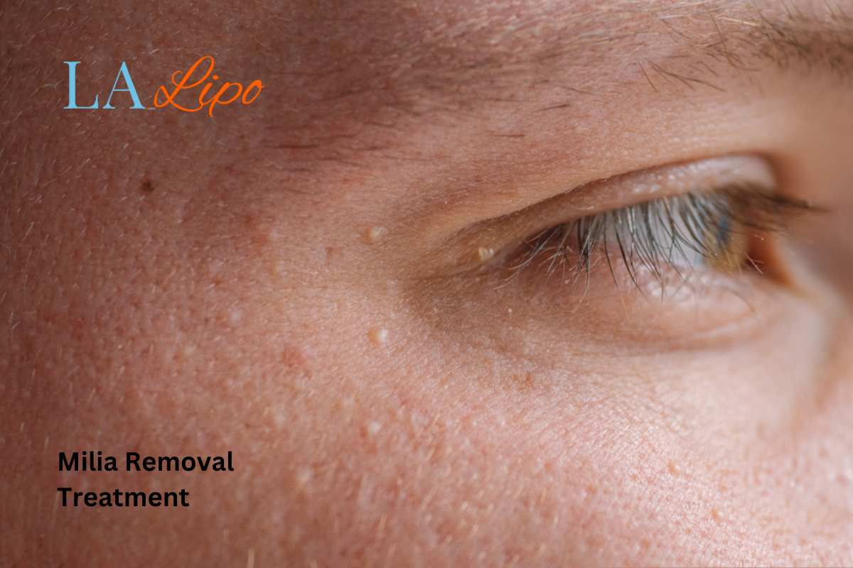 Cryopen Milia Removal: Is It the Easiest and Safest Option Altrincham?