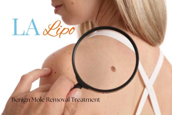 Woman having her inspection of blemish before mole removal Altrincham
