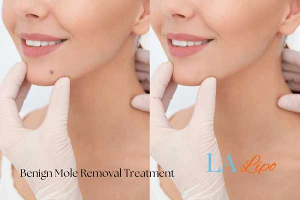 woman's before and after mole removal Altrincham results