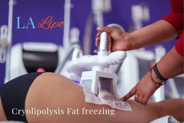 women getting fat freezing Altrincham