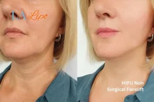hi-fu for wrinkles Altrincham before and after results
