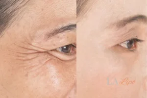 Before and after results of woman - HI-fu wrinkles reduction treatment Altrincham