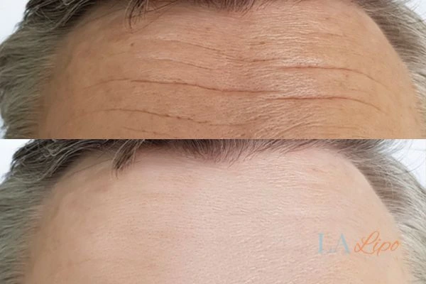 results of HIFU Altrincham on mans forehead to help reduce lines and wrinkles