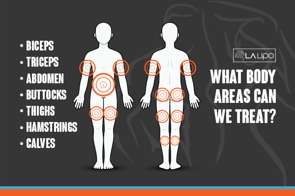 Graphic to show areas you can have LA-EMS Body Sculpting Altrincham treatment.