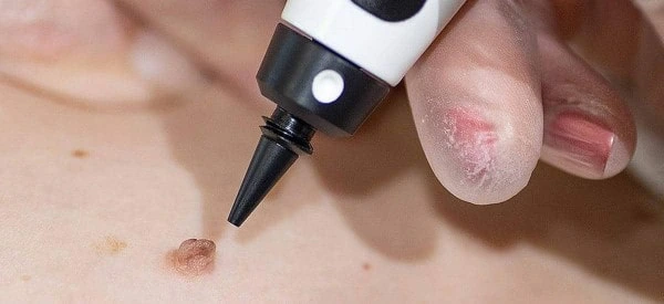 skin tag removal using cryopen Altrincham
