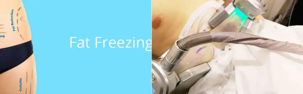multi areas of a persons body having coolsculpting Altrincham treatment