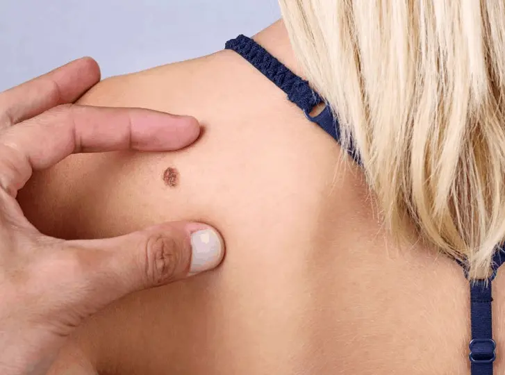 woman having mole removal Altrincham consultation before treatment.