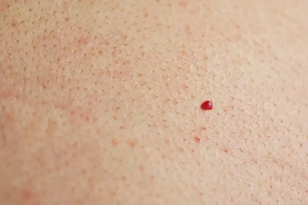 close up of a cherry angioma Altrincham