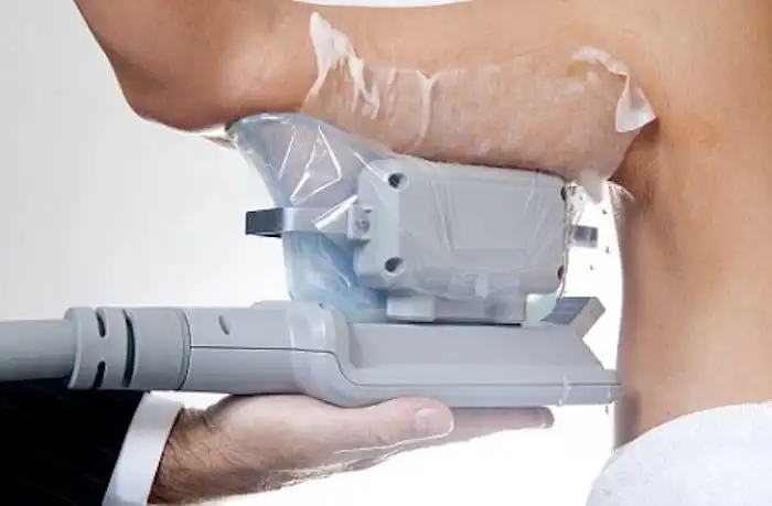 Picture of fat freezing Altrincham on the upper arms.
