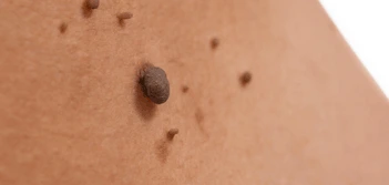 image of a skin tag Altrincham