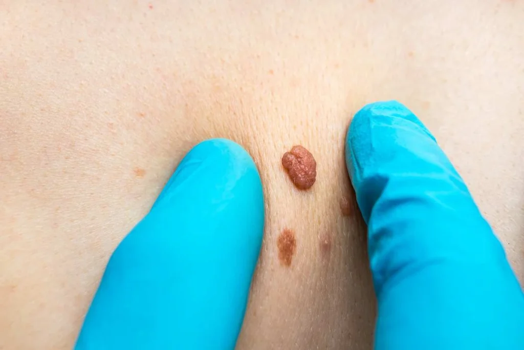 Consultant examining a skin tag Altrincham