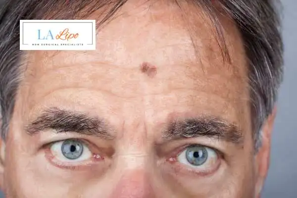 Solar Lentigo Removal Altrincham image of man with mark on his forehead