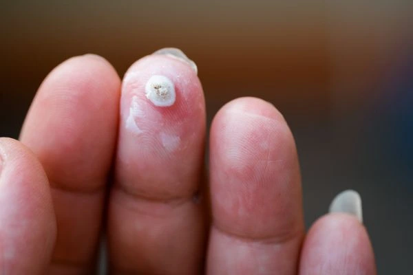 wart on person finger - cryotherapy to treat from LA LIPO Altrincham
