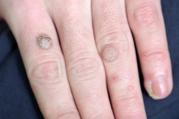 photo of warts on person hand - see wart removal Altrincham from LA LIPO