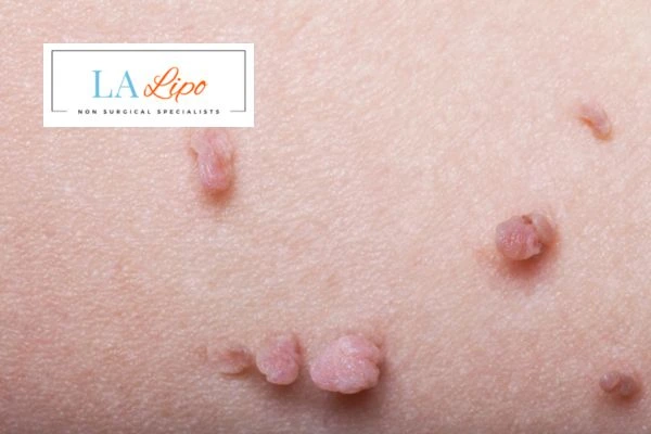 Does cryopen skin tag removal Altrincham hurt? Find out now call our team today!