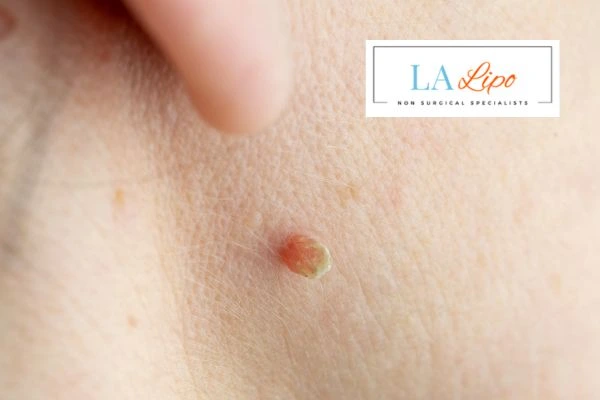 Book skin tag removal Altrincham today speak to our team now!
