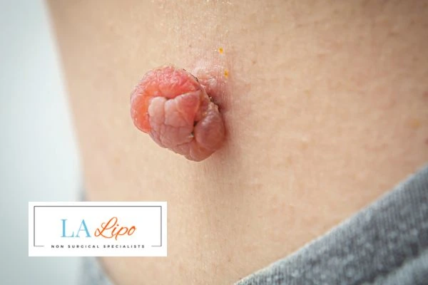 Interested in skin tag removal Altrincham? Concerned about the pain? Find out more today!