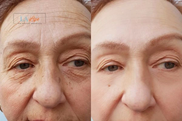 The powerful benefits of Morpheus8 Treatment Altrincham - Call Our team today!