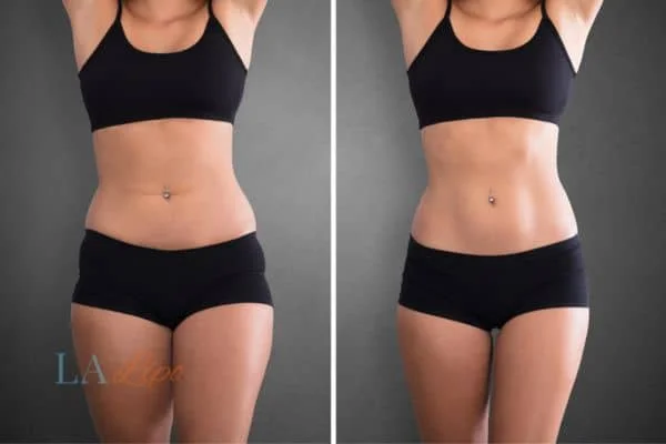 before and after results of non-surgical treatment to help a woman's body image and mental health Altrincham