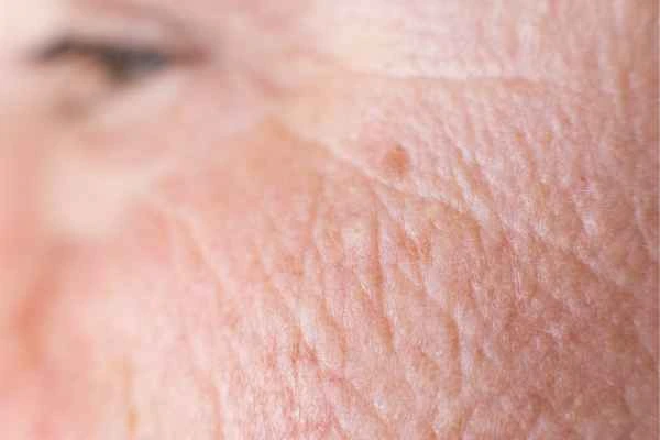 close up picture of a woman's face showing an age spot Altrincham