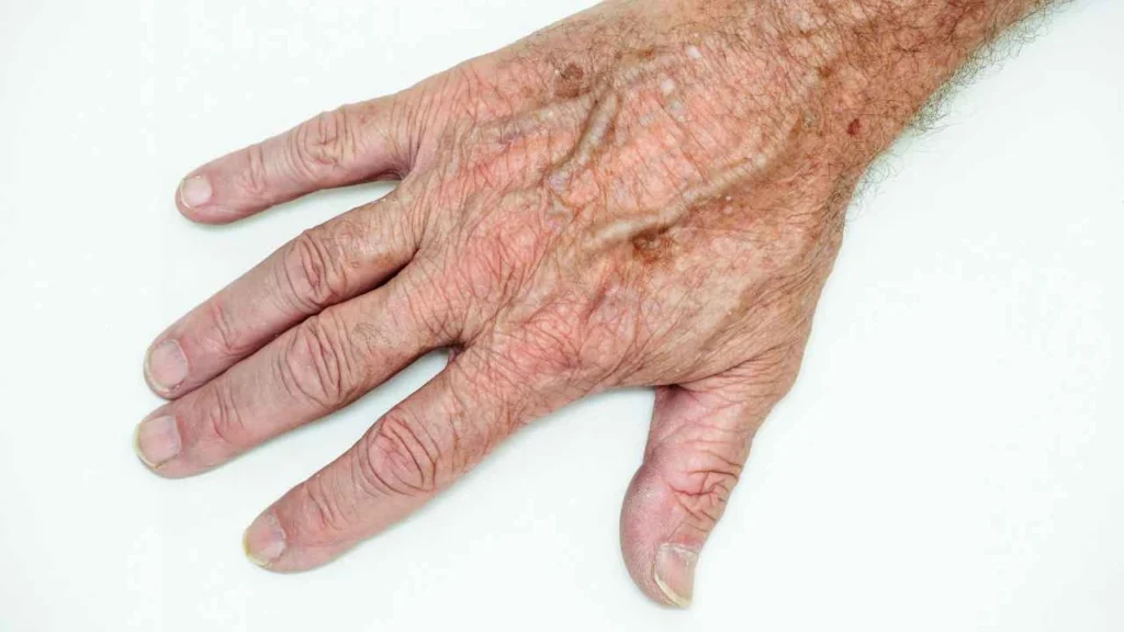Male hand showing age spot Altrincham