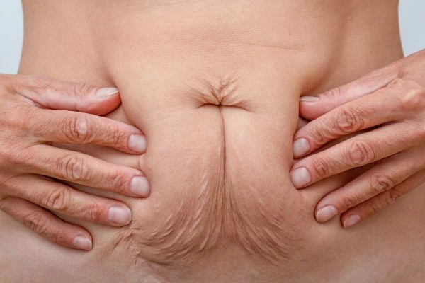 Image of a woman's stomach with loose skin - example of skin tightening Altrincham options