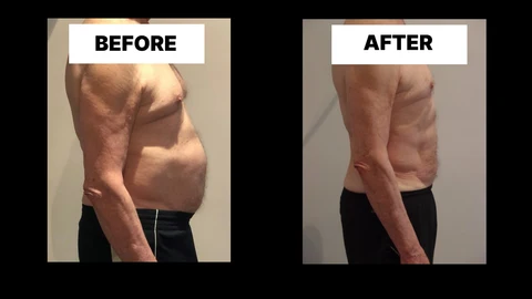 What Symptoms Can Diastasis Recti Cause in Men? Weak Core, Back Pain and Poor Posture Altrincham
